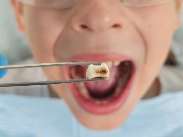 Best Emergency Dental Filling Replacement  in Blue Ash, OH
