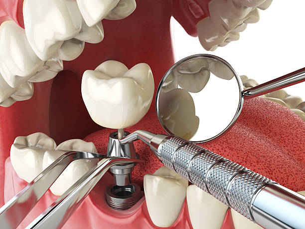 Best Urgent Tooth Repair  in Blue Ash, OH